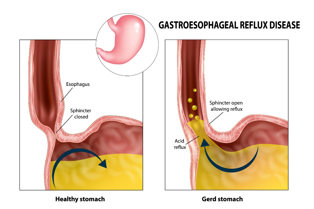 Gastroesophageal reflux: oesophagus, sphincter, stomach and stomach acid