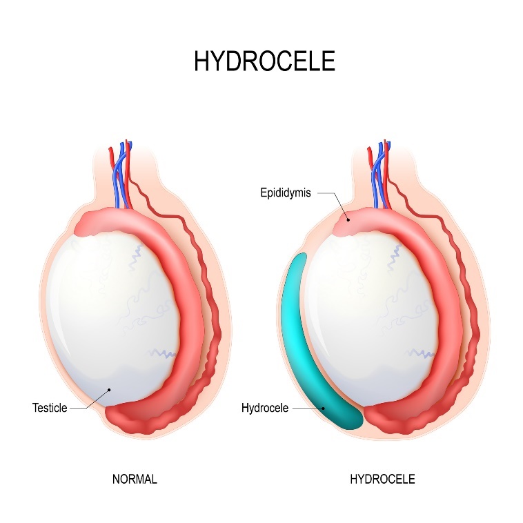 Hydrocele: testicle, epididymis, Hydrocele (accumulated fluid)