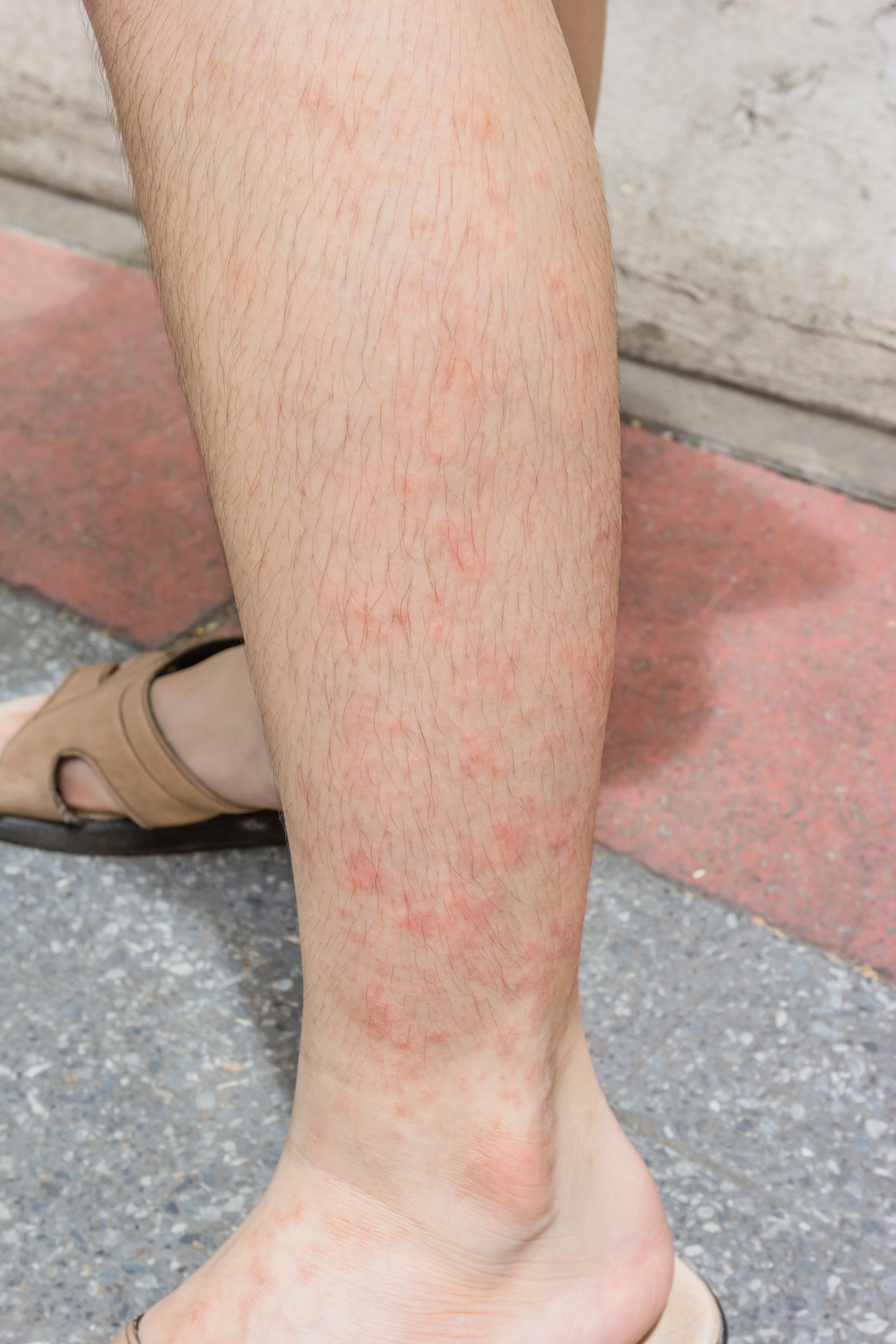 skin redness in contact eczema