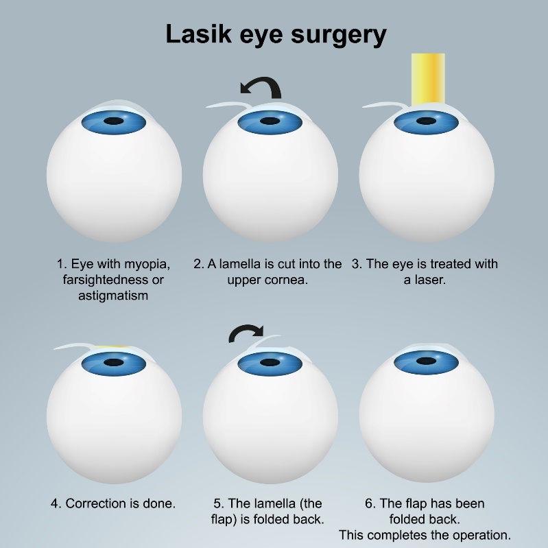 Laser eye surgery LASIK - subsurface method. Procedure with flap/flap without damaging the nerve endings.