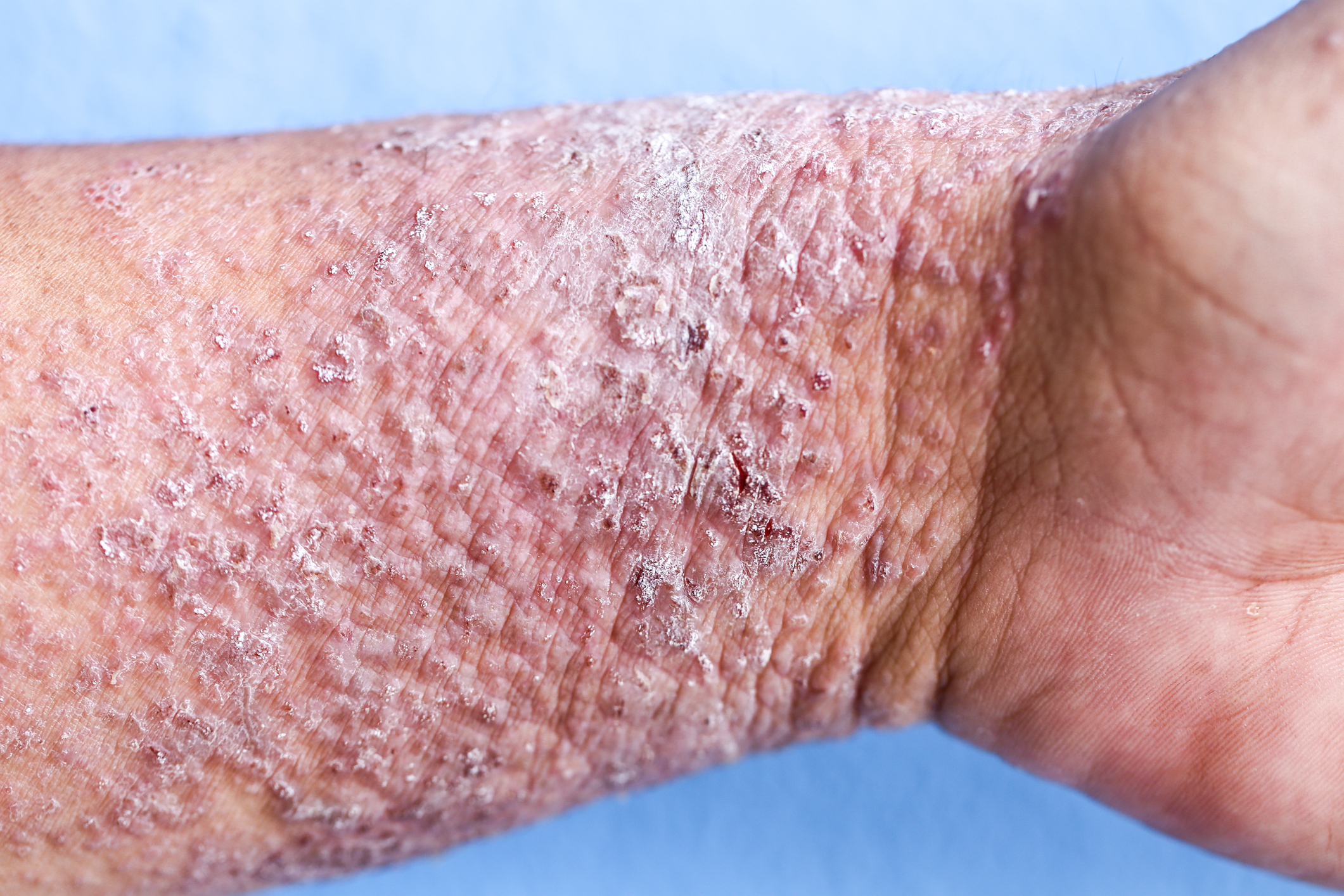 lichenification - skin thickening in atopic eczema