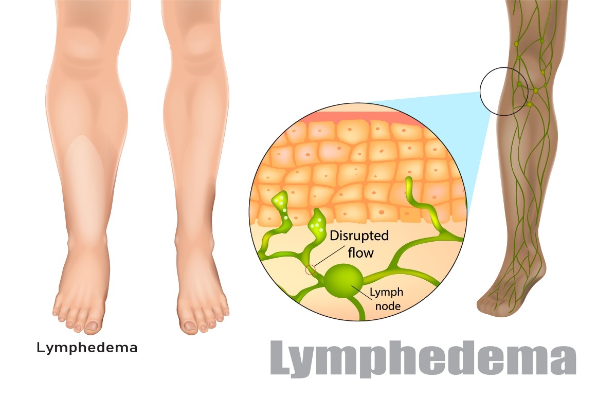 Lymphedema