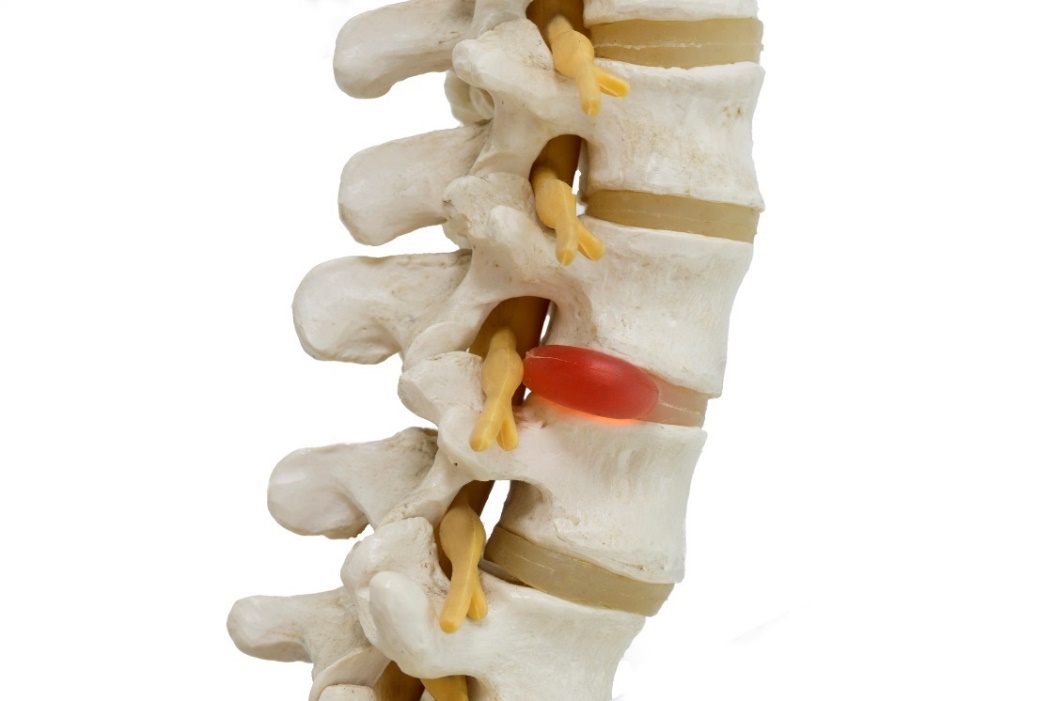 Anatomical representation of a 3D model of the spine, intervertebral discs and herniated disc with nerve compression