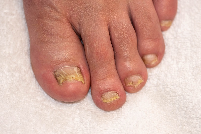 Mycotic infection of toenails