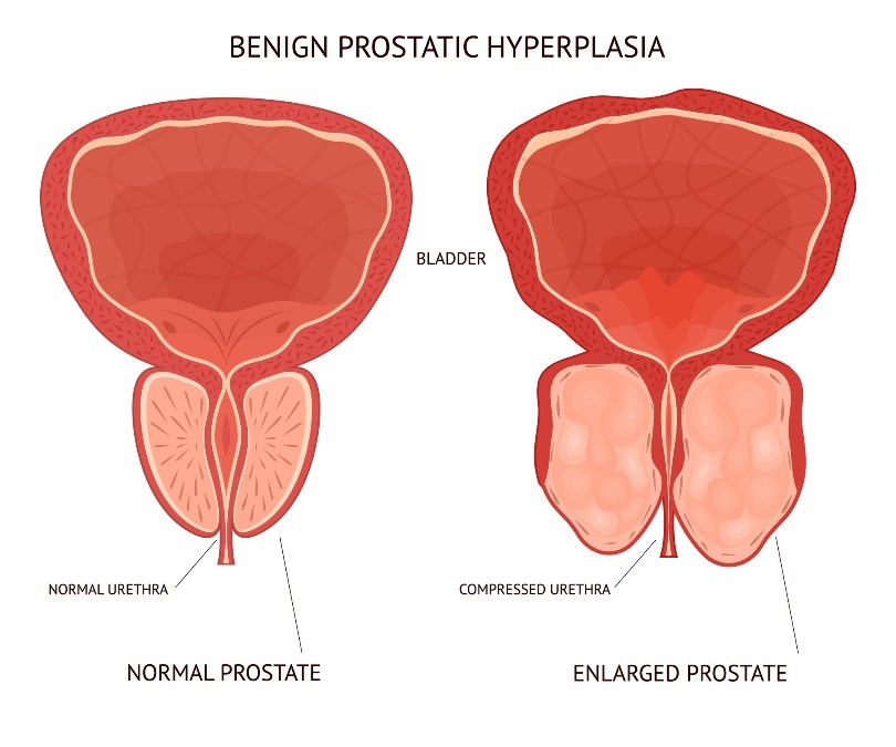 benign enlargement of the prostate. bladder, physiological and enlarged tissue of the prostate organ.