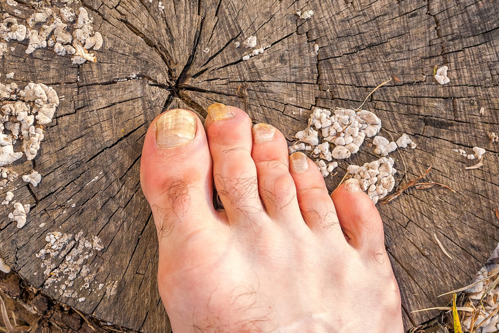 a foot with fungus on its nails, lying on a tree stump