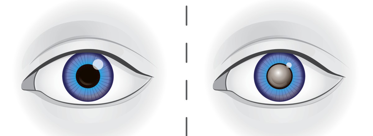 Left: An eye with a healthy lens. Right: an eye with a cloudy lens in cataract.