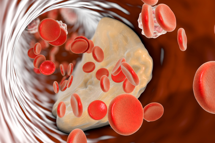 a cross-section of a blood vessel, with red blood cells, fat particles and atherosclerotic plaque inside