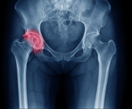 X-ray of the pelvis, right hip joint affected by arthrosis