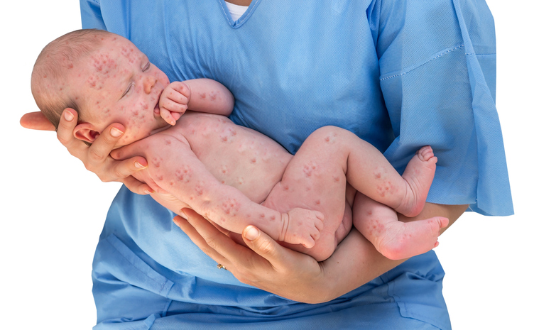 a child with skin seeding on the hands of a doctor