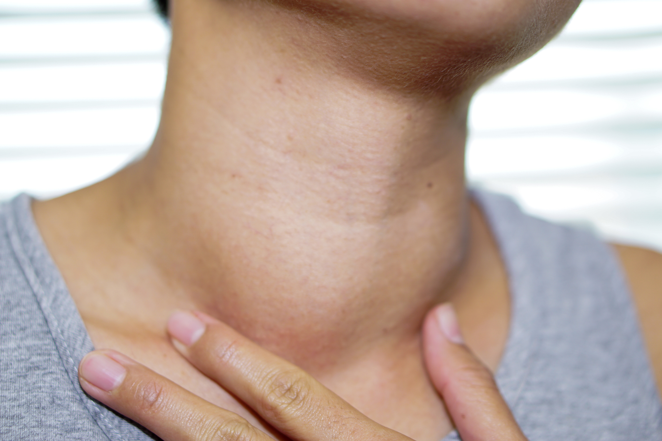 Visible enlargement of the thyroid gland, called goiter, is a very common consequence of insufficient iodine intake in the diet.