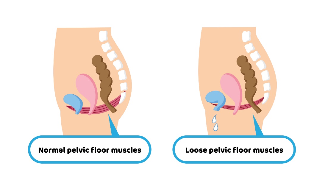 Physiological condition of the pelvic floor musculature and permissive condition of the pelvic floor musculature resulting in incontinence