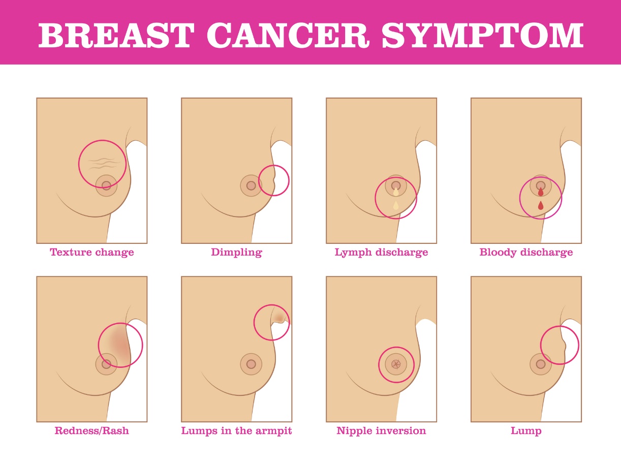 Symptoms of breast cancer: change in the structure of the breast, change in the colour and surface of the breast, discharge and nipple retraction, localisation of the lump.