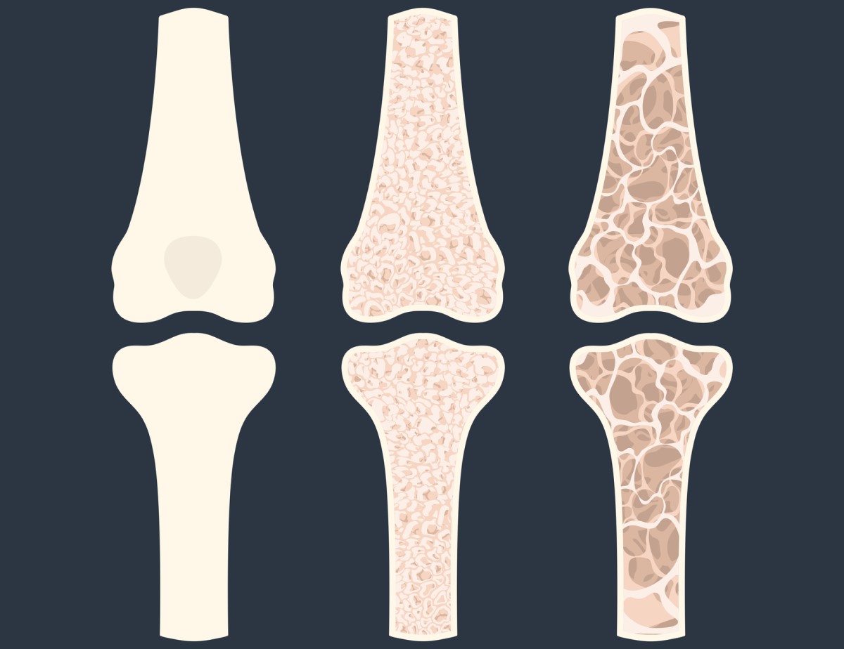 Animation of three bones showing osteoporosis - thinning of bones