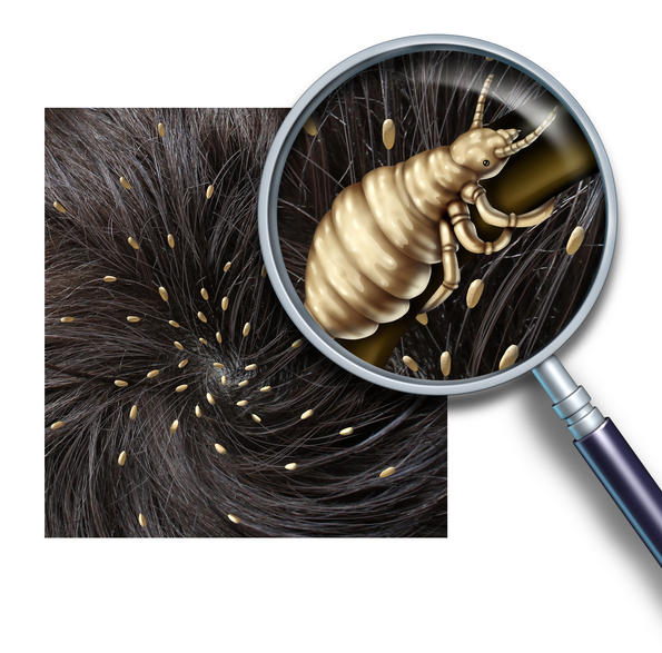 Detail of a hair with nits, through a magnifying glass a view of a louse.