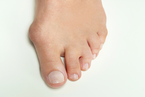 foot with bunion