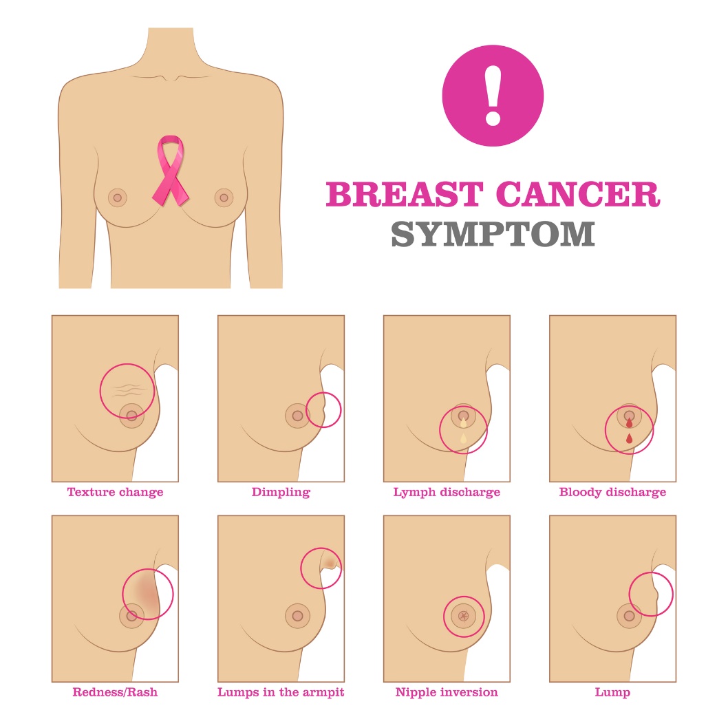 Manifestations to look for during breast examination: change in texture, Depression, Nipple discharge - lymph/blood, Redness, Bulge in the armpit, Nipple retraction, Bulge.