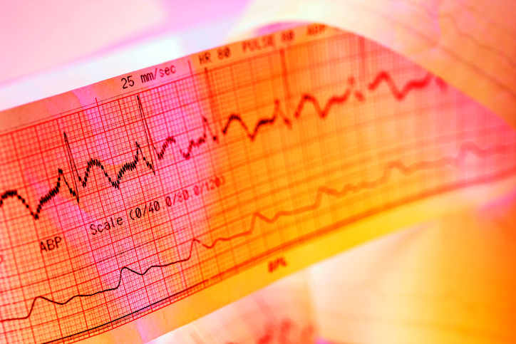 ECG recording