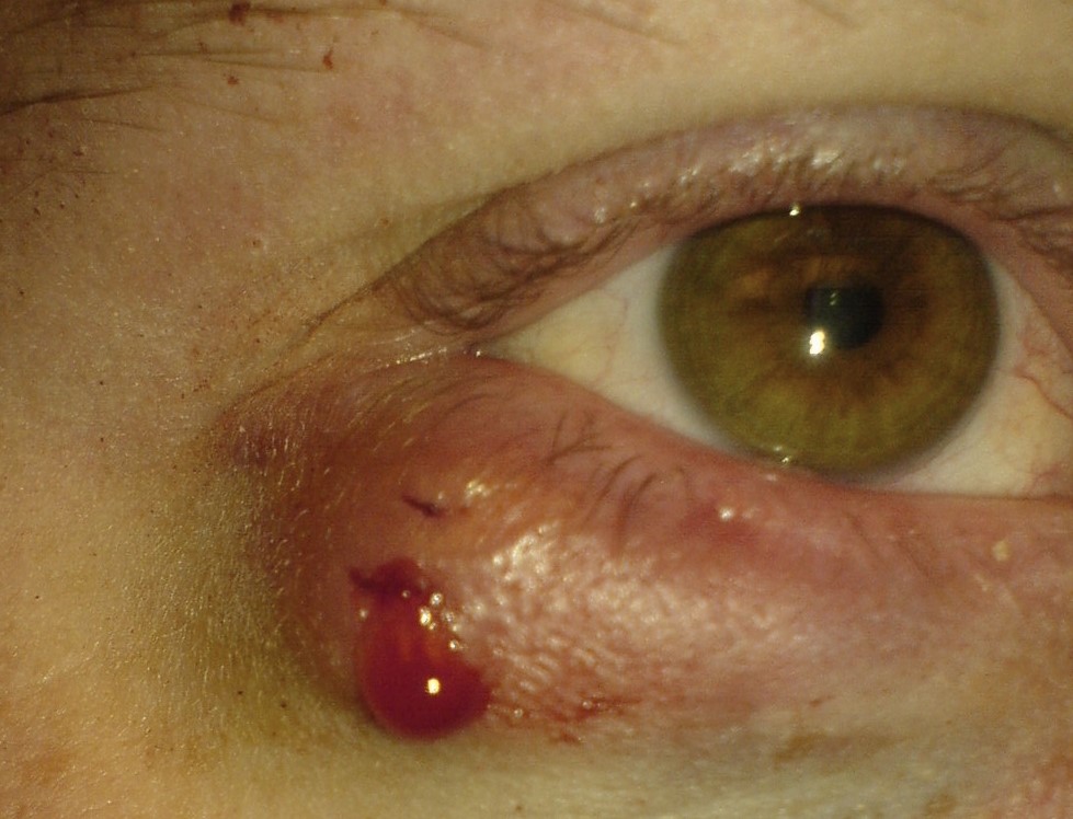 Chalazion, i.e. wolf's grain bleeding after impaction, to relieve pressure, eyelid affected by inflammation, right eye