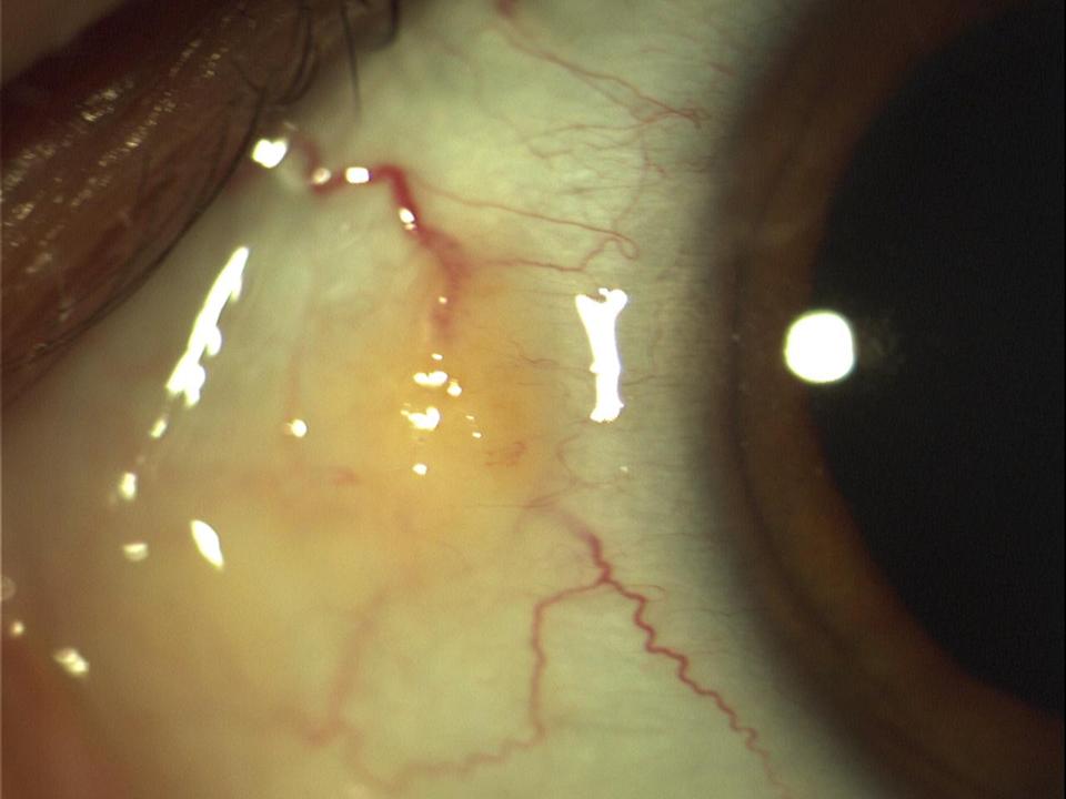 Eye with pinguecula disease
