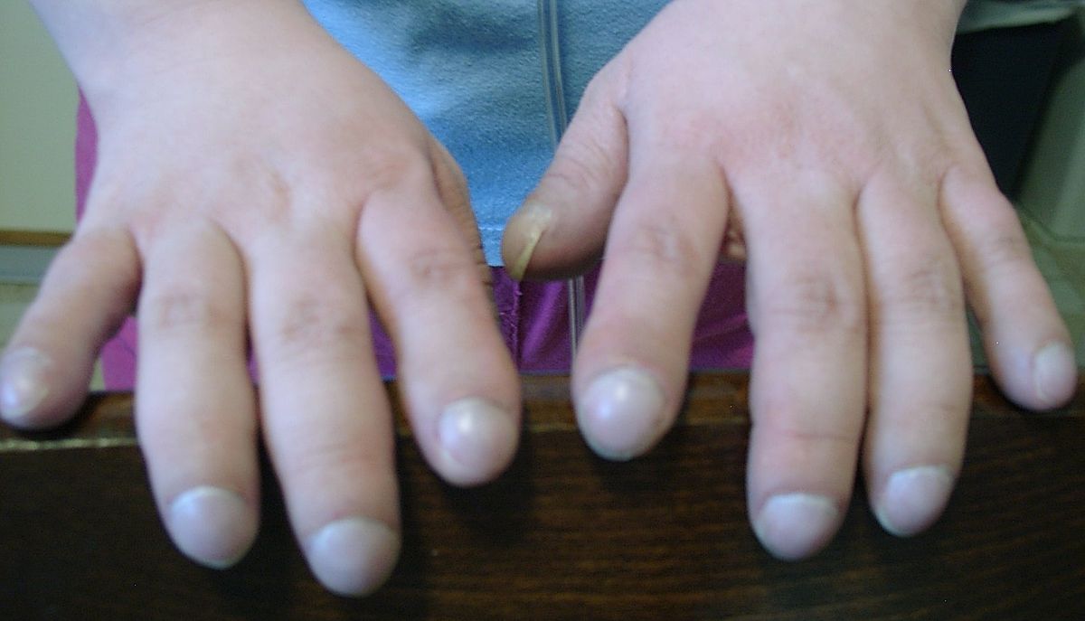 Stubby fingers as a symptom of Eisenmenger syndrome