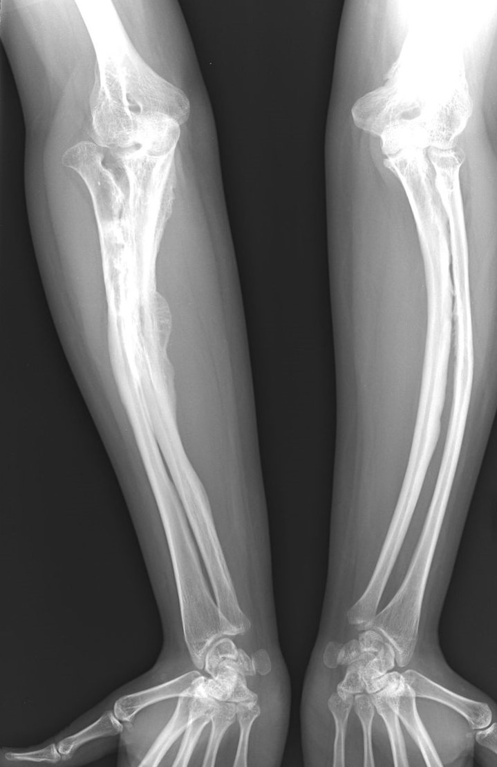 Radiographs of osteogenesis imperfecta disease in an adult