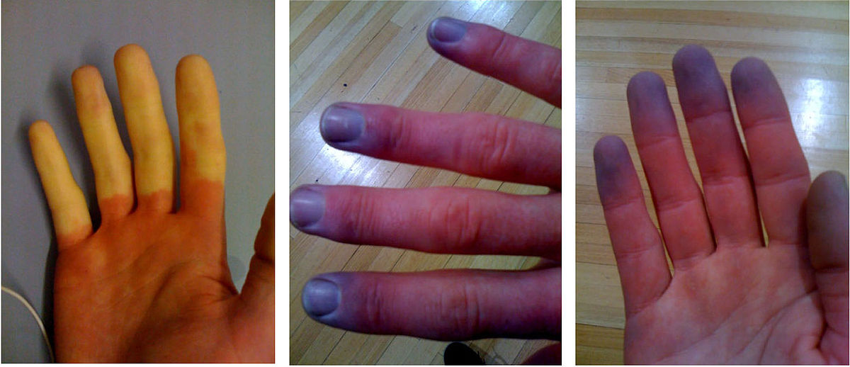 Hand discoloration in Raynaud's syndrome, acral cyanosis