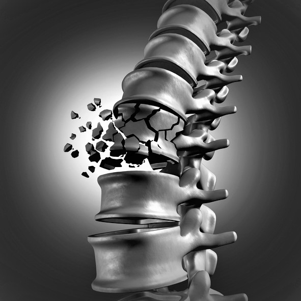 Vertebral fracture of the spine