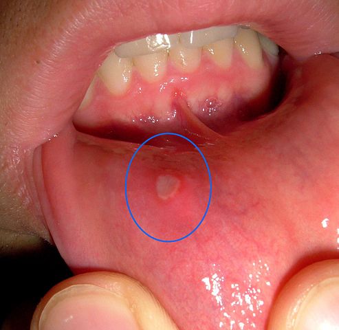 aphthae on the lower lip