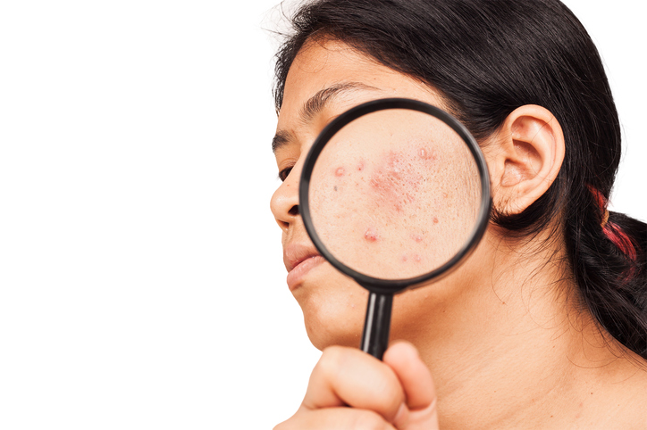 Woman has acne on face, enlargement under magnifying glass