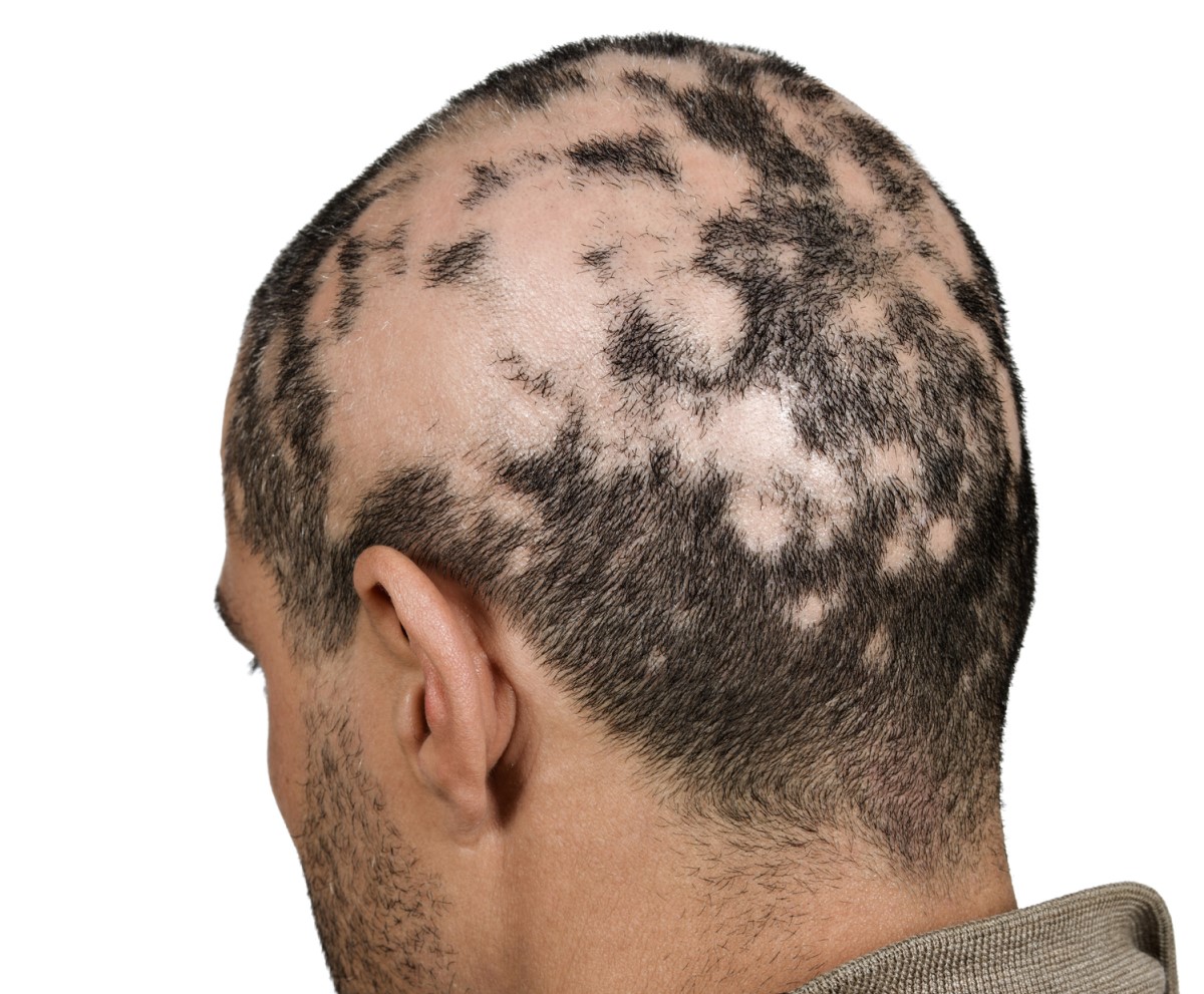 Male head - hair fall - excessive hair loss in the form of islets - alopecia areata.