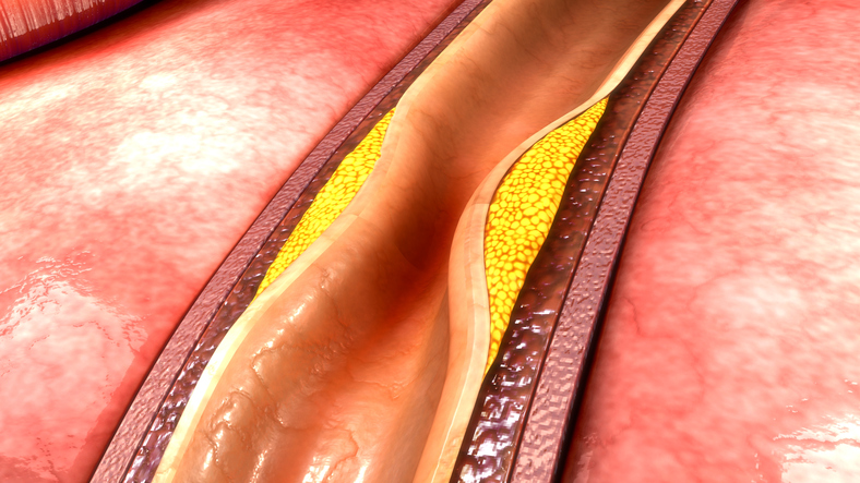 atherosclerosis, fat deposition in the vessel wall