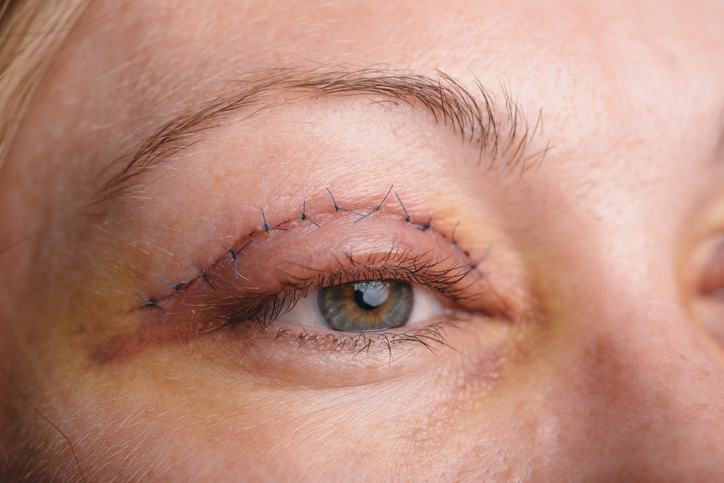 Woman, face and eyelid after blepharoplasty - blepharoplasty