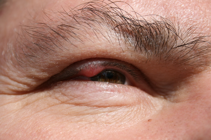 A man has an inflamed upper eyelid of the right eye, inflammation of the sebaceous glands, chalazion, i.e. wolf's mane