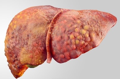 Damaged liver and its function for cirrhosis of the liver, a consequence of alcoholism