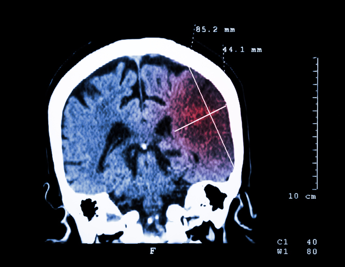 Brain damage visible on CT scan