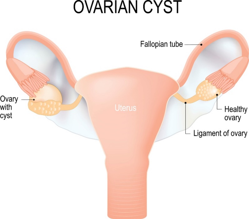 Cyst on the ovary