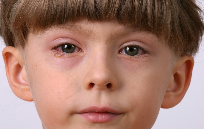 The child has an inflamed eye, red and swollen