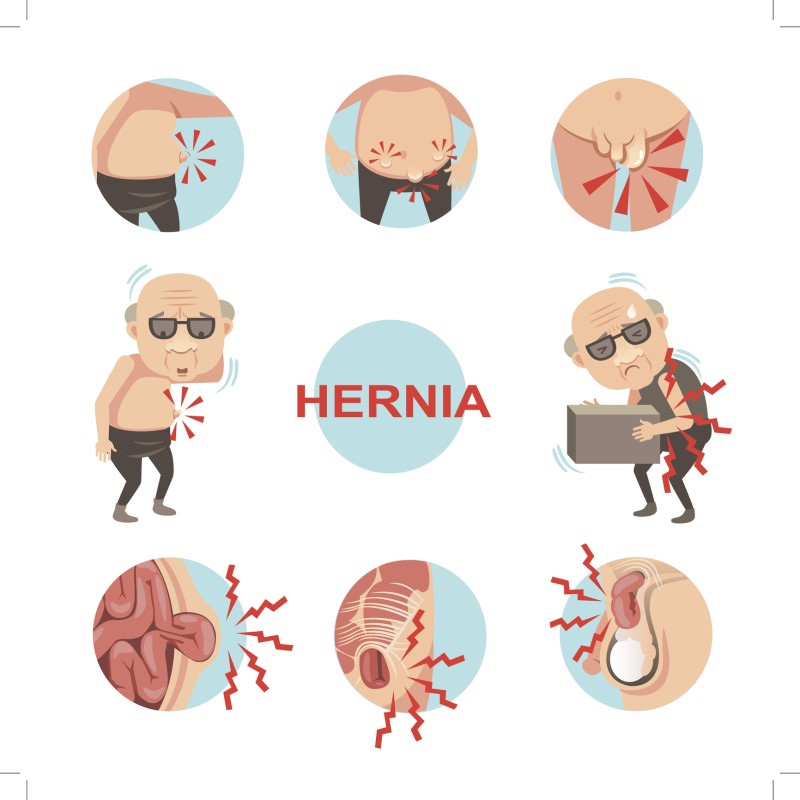 Hernia - model of symptoms