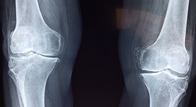 X-ray of the knee joints