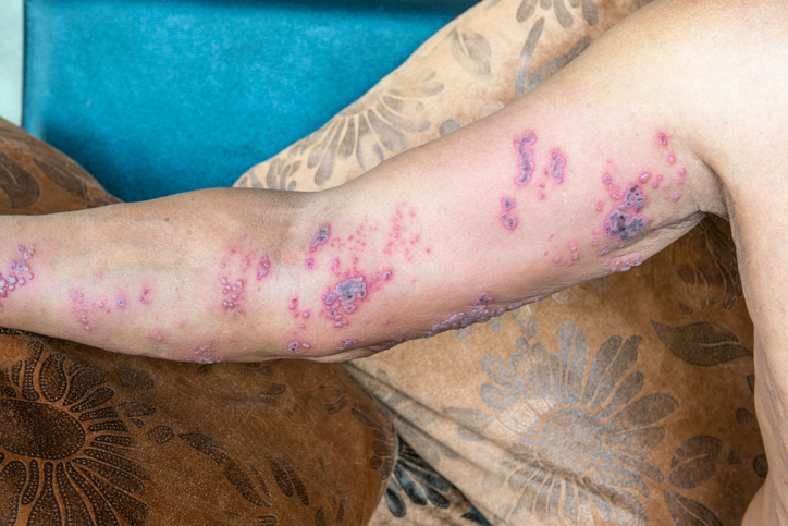 Skin infection on the right upper limb in herpes zoster, nerve pain in the area is also present.