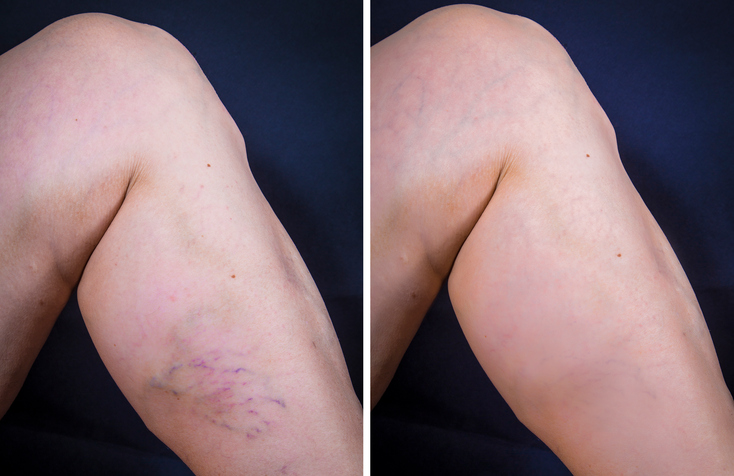 Comparison of shins with and without varicose veins