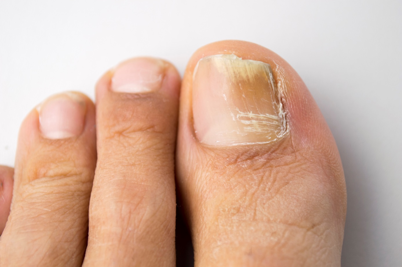 Brittle nails and visible brittleness of nails on the lower limbs, feet.