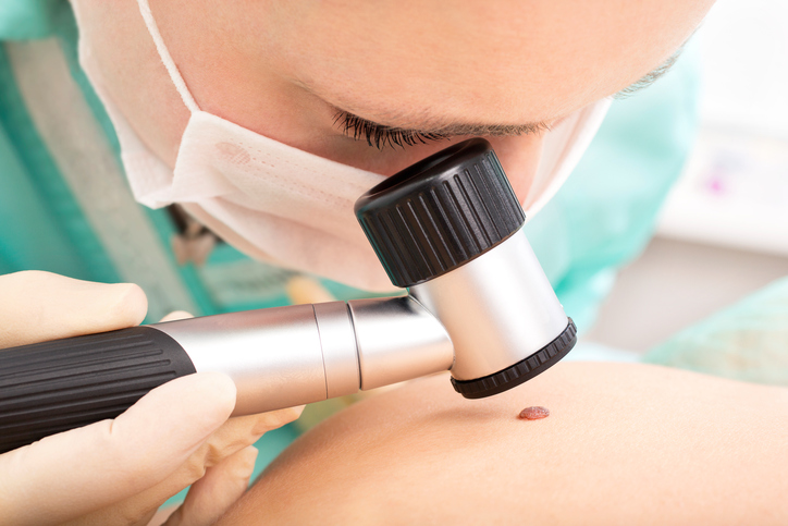 the doctor examines the skin mole with a dermatoscope