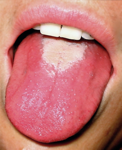 Raspberry tongue in scarlet fever