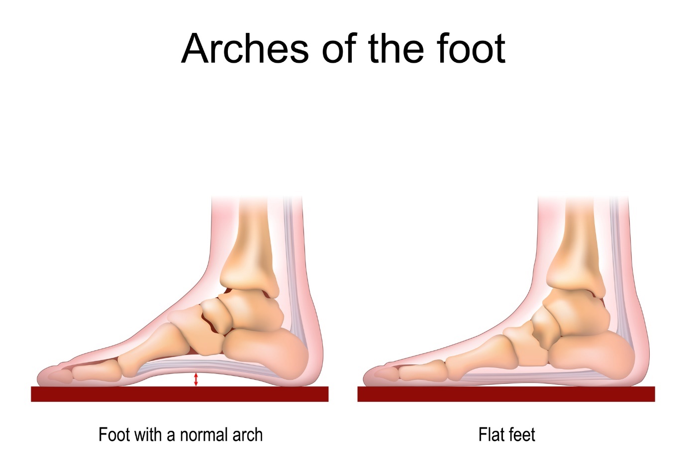Normal and flat foot