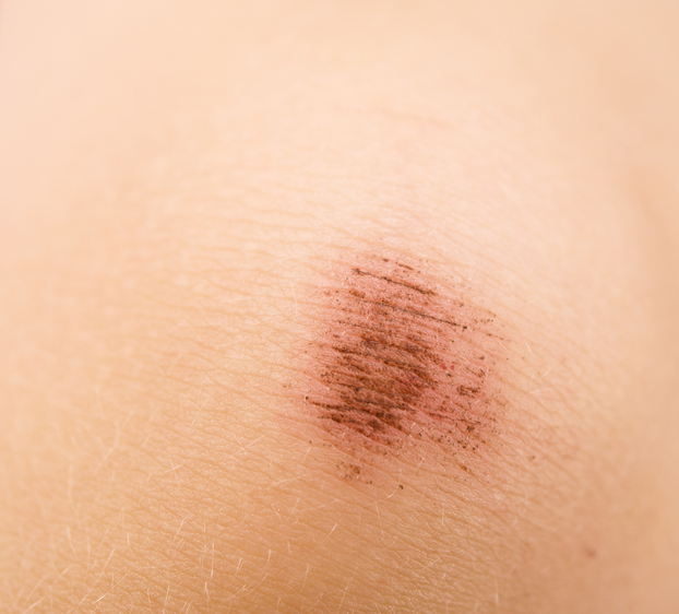 Abrasion on the skin, also indicates skin pain
