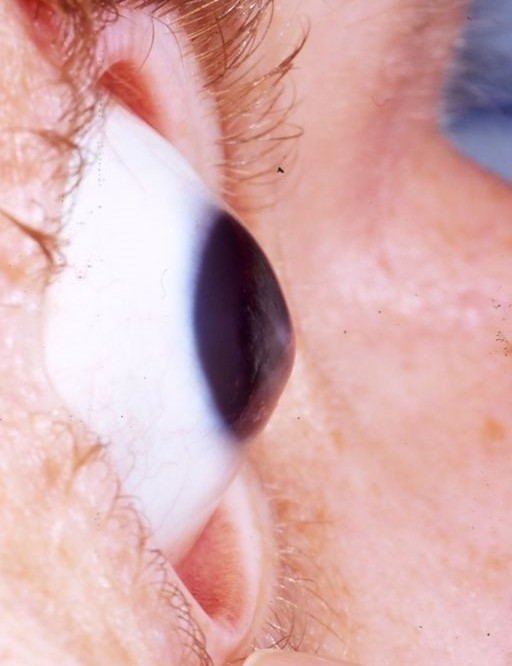 Keratoconus, degeneration of the cornea