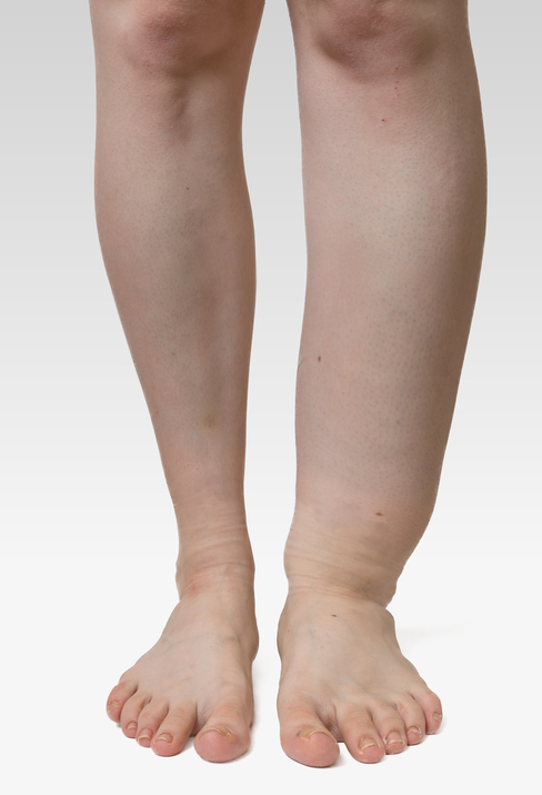 Swelling on the side of the lower limb, left lower limb without swelling, right swollen, high swelling, from leg to knee