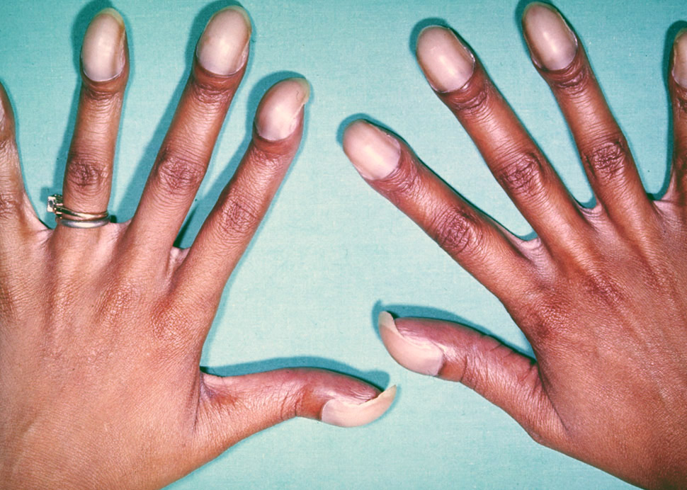 A woman has stubby fingers as a symptom of disease, and this Fallot tetralogy